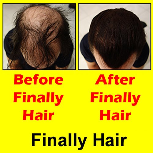 Finally Hair Building Fibers Medium Blond 28g Bottle of Fibers and Finally Hair 120ml 4.1 Oz. Bottle Hair Loss Concealer (Medium Blonde (Light Medium Blonde))