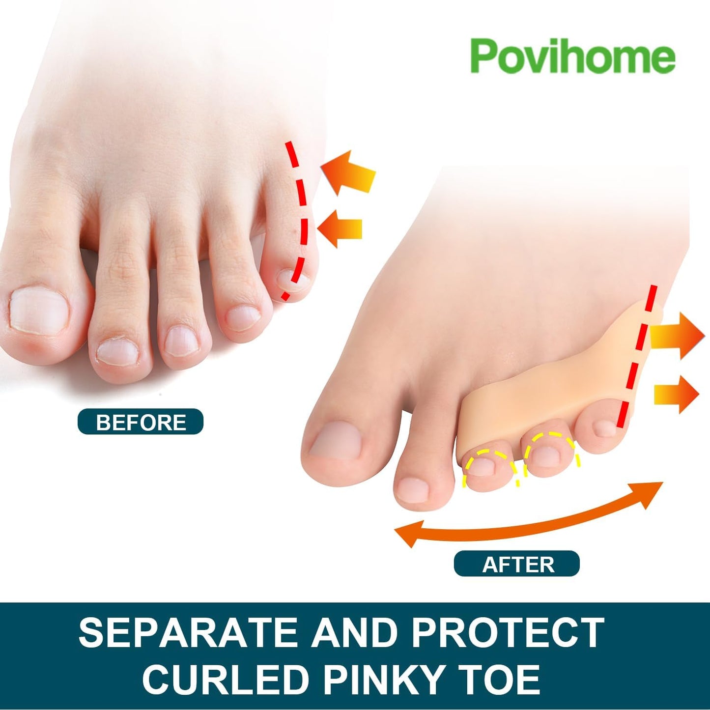 Povihome 10 Pack Pinky Toe Separator and Protectors for Overlapping Toe, Curled Pinky Toes - Spacers for Morton's Neuroma Pain Relief, Firm Support, Beige