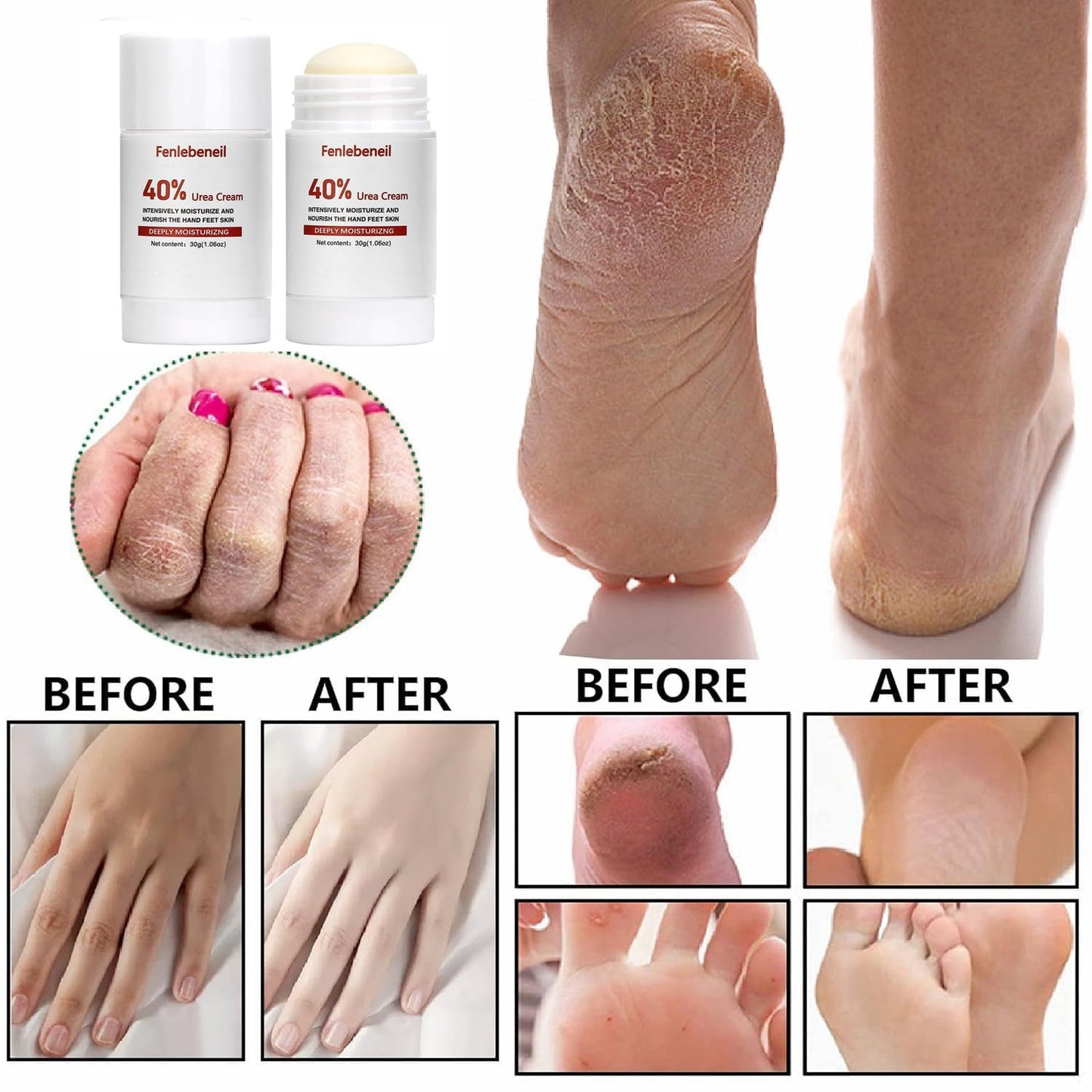 40% Urea Cream Cracked Heel Balm with 40% for Dry, Cracked, Heals Feet Hand Moisturizing Lotion 40 Percent Urea Lotion for Feet Maximum Strength 3Pack