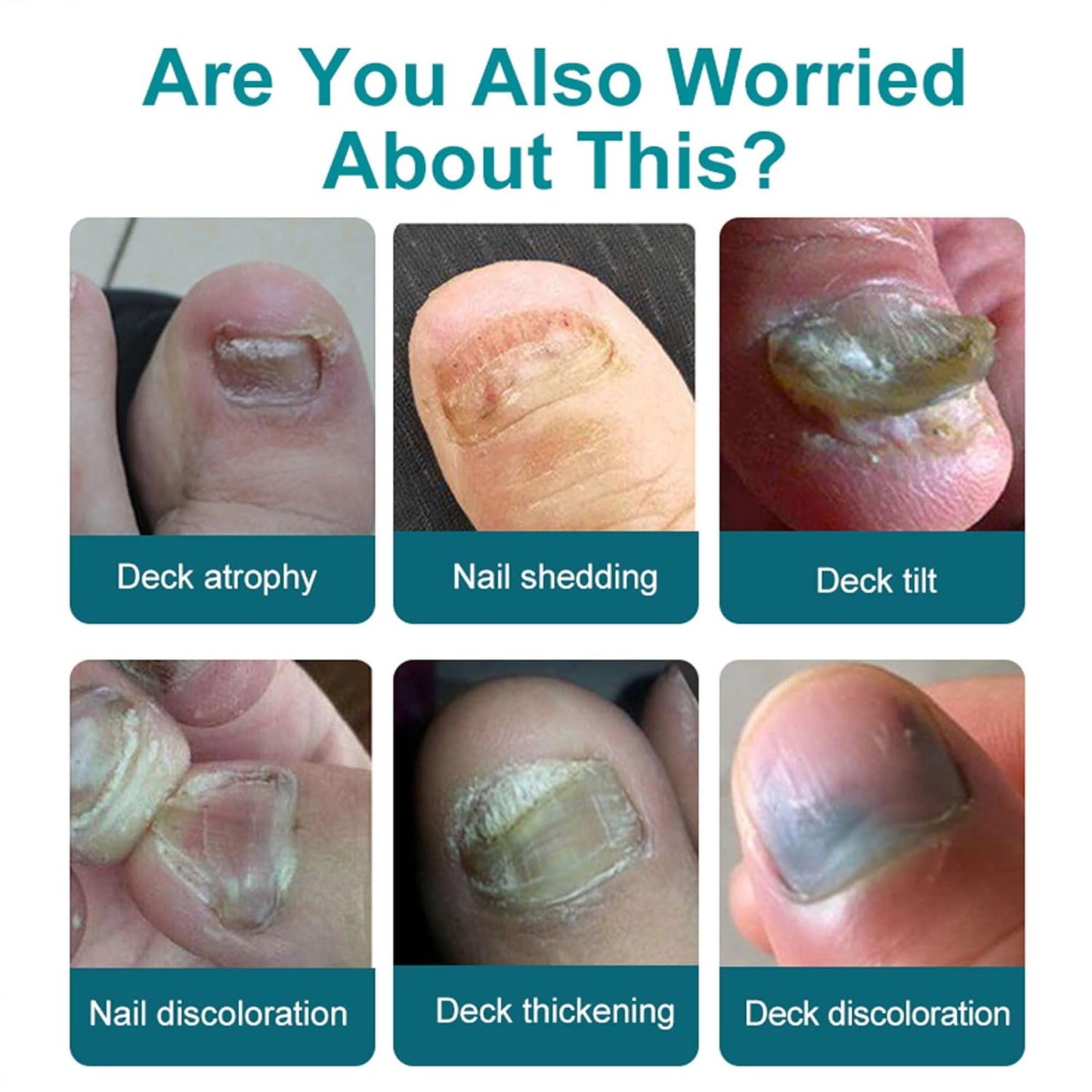 Multi-Purpose Nail Solution - Strengthener & Growth Treatment for Damaged Nails, Repair Care - Protects, Repairs & Aids Mild Onychomycosis Daily Recovery