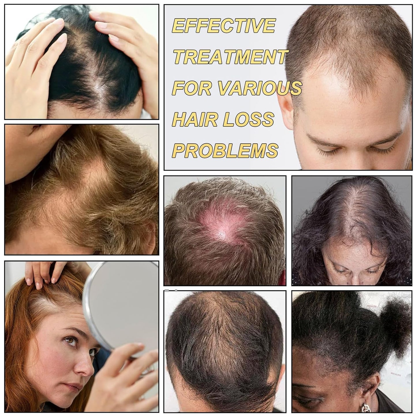 5% Minoxidil for Men and Women Hair Growth Serum, Biotin Hair Growth, Hair Regrowth Treatment for Scalp Hair Loss Hair Thinning for Thicker Longer Fuller Healthier Hair (Pack of 2)