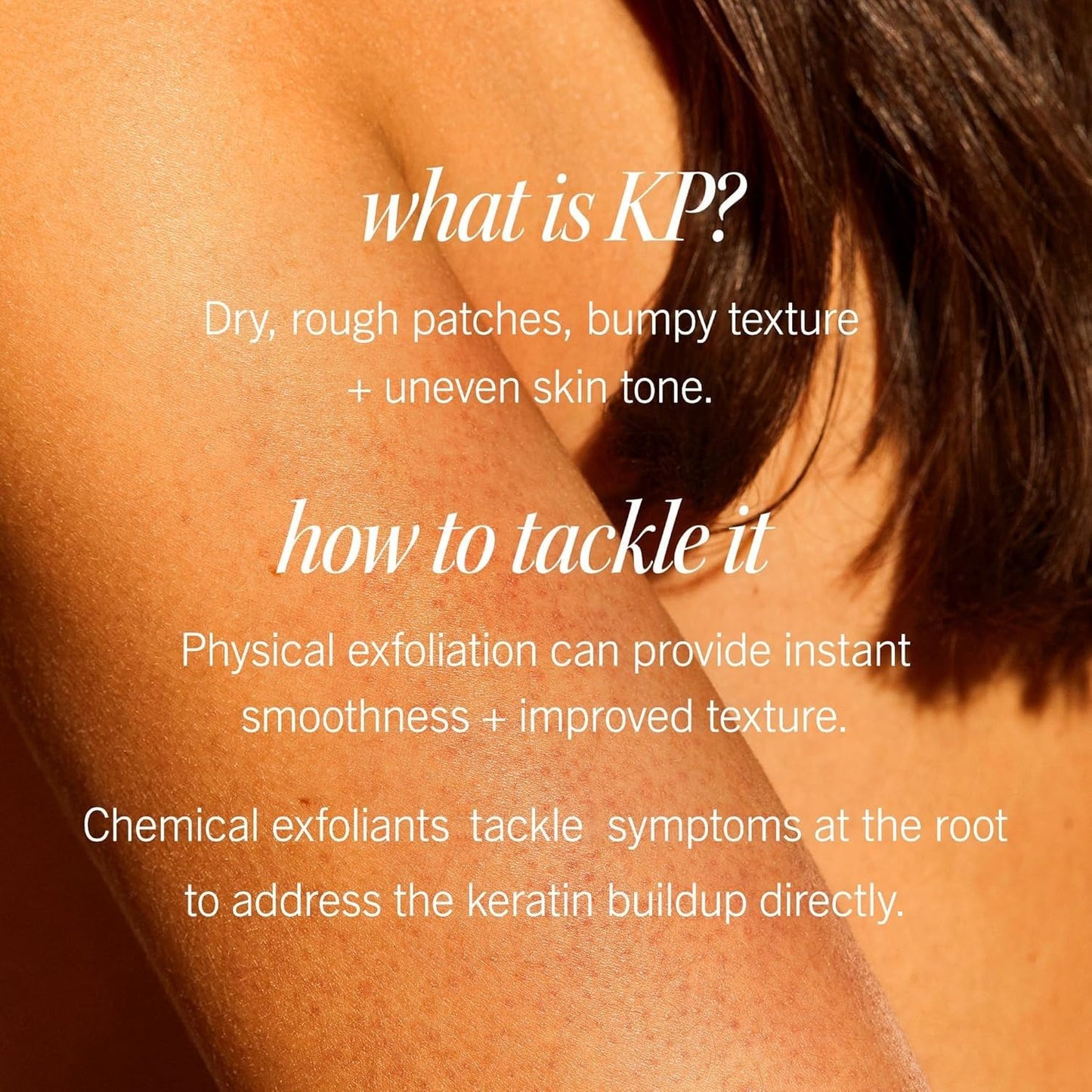 First Aid Beauty - KP Bump Eraser Body Scrub with 10% AHA, Keratosis Pilaris Exfoliator with Glycolic and Lactic acids, Helps Reduce Chicken Skin Bumps, Safe for Sensitive Skin, Peach Scent (2 oz)